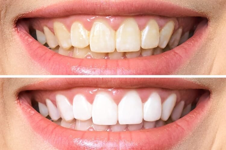 Diy teeth whitening remedies