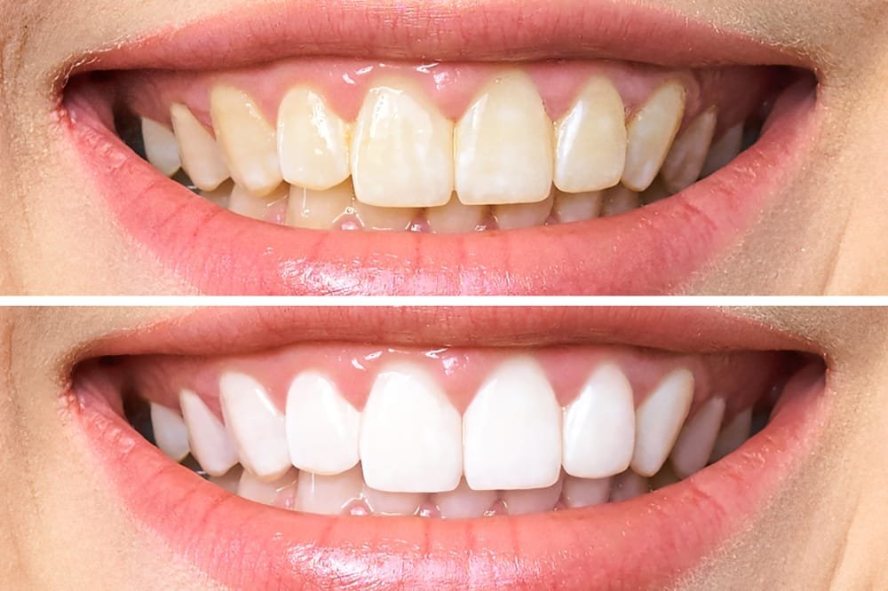Diy teeth whitening remedies