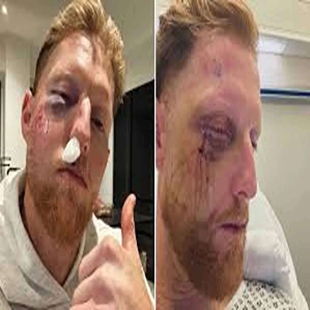 Injury update ben stokes recovering after