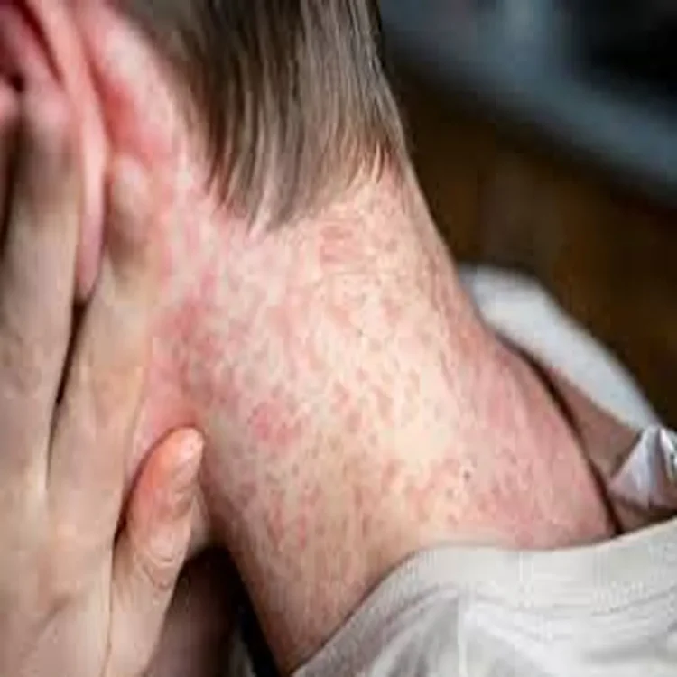 Measles cases rising nsw