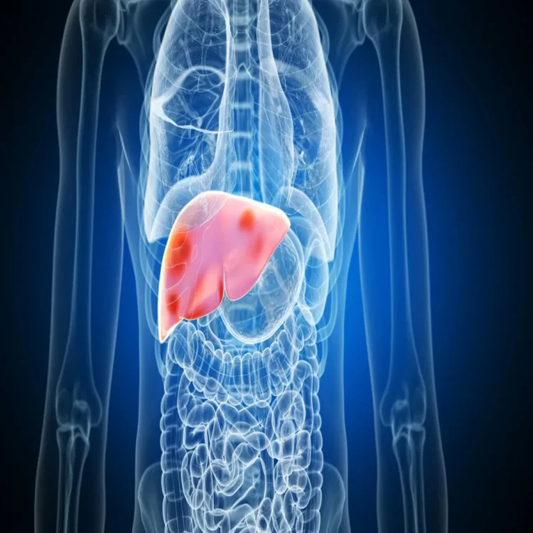 Fatty liver rise india