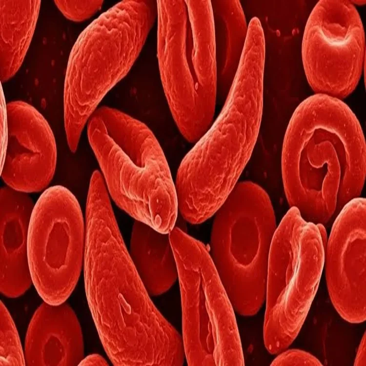 Sickle cell disease india fight