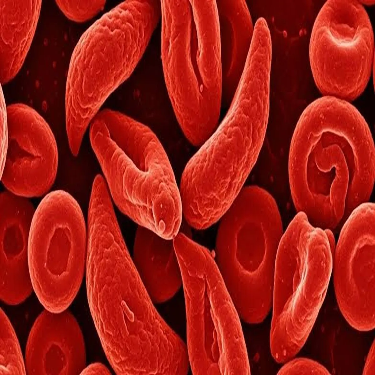 Sicklecelldisease india strengthens fight against genetic