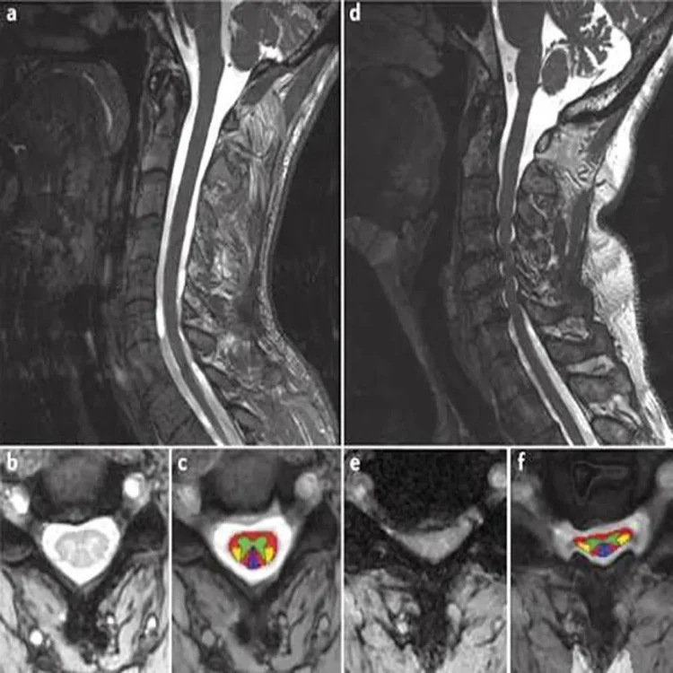 Cervical myelopathy spine research